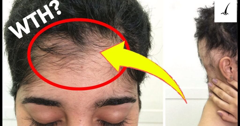 what-are-the-side-effects-of-minoxidil