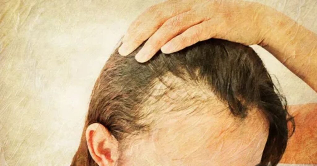 Chlorine causes hair loss