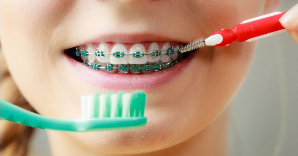 cleaning-considerations-of-color-braces